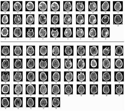 Quantitative pupillometry and radiographic markers of intracranial midline shift: A pilot study